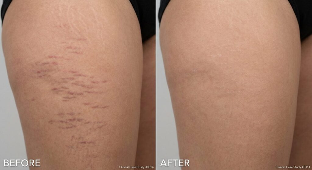Before and after comparison split-screen of stretch marks on